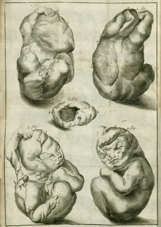 Planche dépliante gravée sur cuivre avec cinq figures montrant le foetus de pierre sous différents angles
