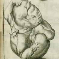 Planche dépliante gravée sur cuivre avec cinq figures montrant le foetus de pierre sous différents angles